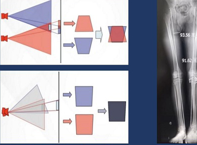 拍攝全脊柱X光片 長骨拼接技術(shù)和一板成像的區(qū)別