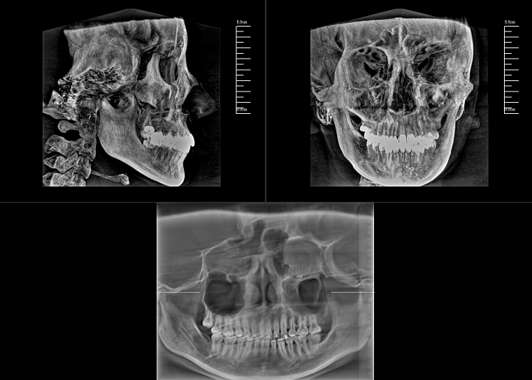 數字化口腔CBCT影像