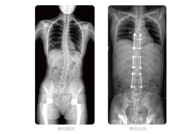 動態DR的全脊柱臨床影像