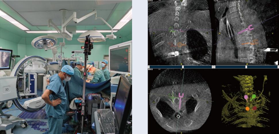 術中三維C形臂影像在脊柱導航機器人系統中的應用