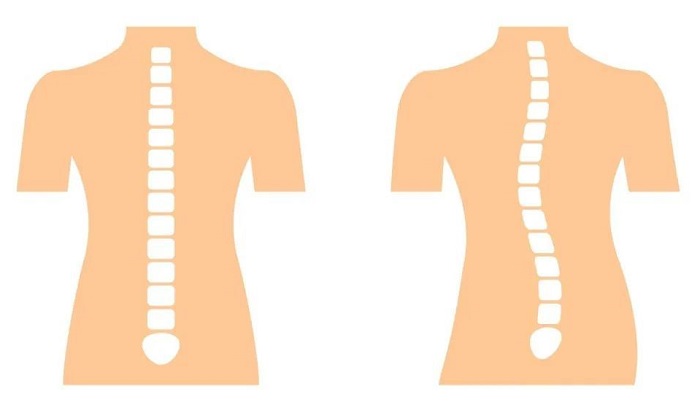 正常脊柱和脊柱側(cè)彎的對(duì)比