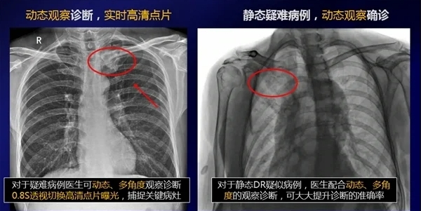 動態DR和靜態DR圖像對比