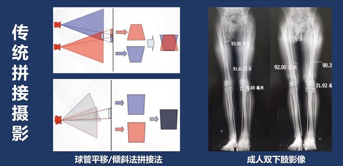 長骨拼接技術(shù)拍攝全脊柱X光片